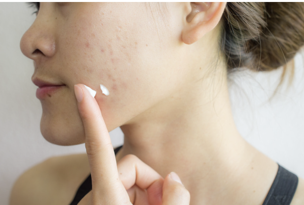 Acne Clearing Gel